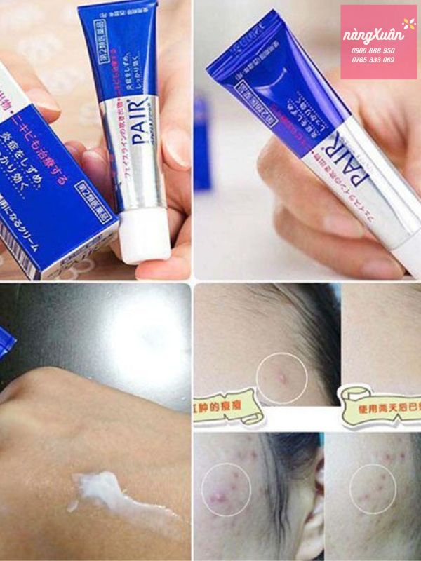 Kem trị mụn PAIR ACNE W Cream 24g Nhật chống viêm.